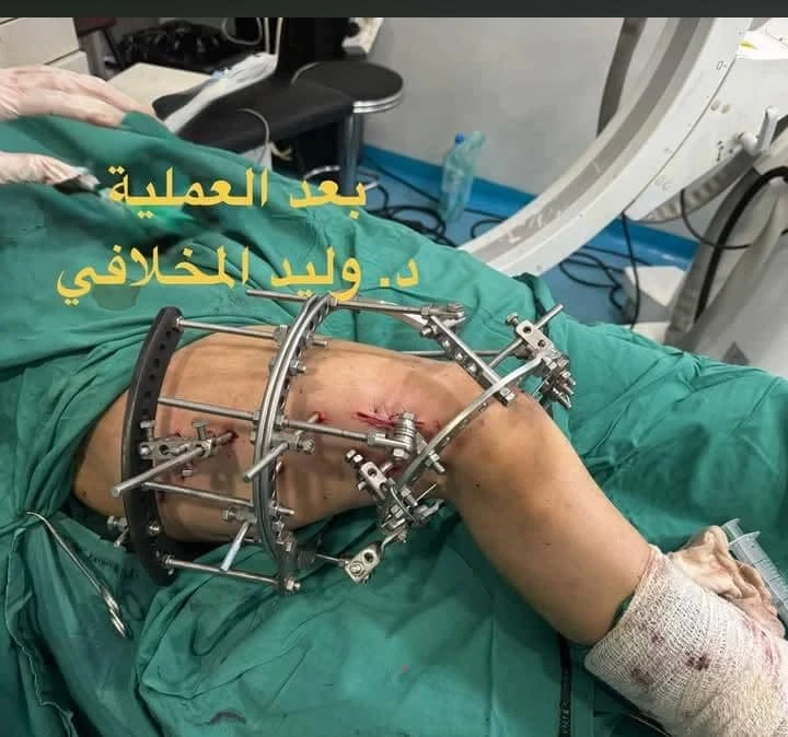بعد العملية